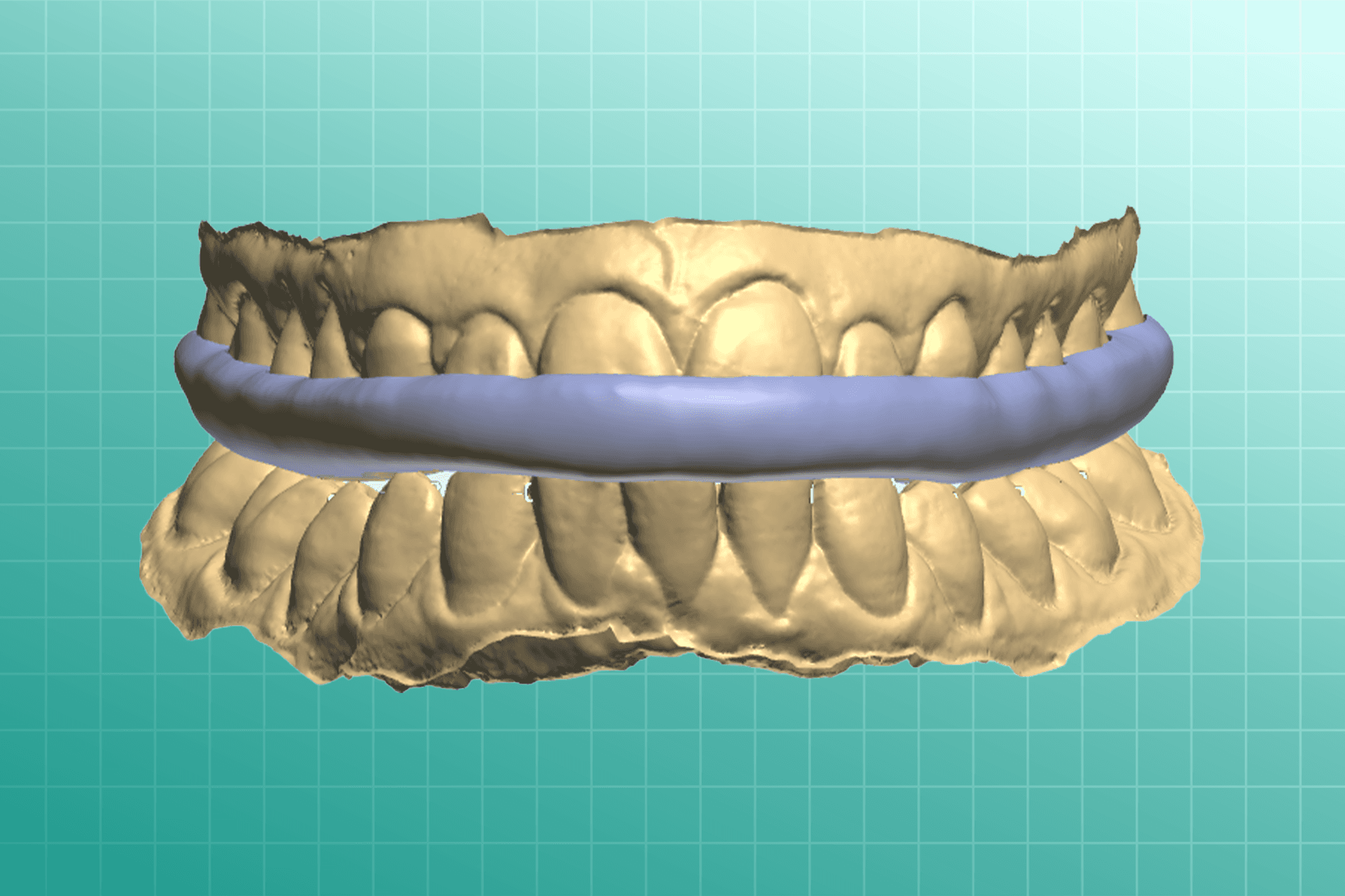 Sport Guards dental prosthesis