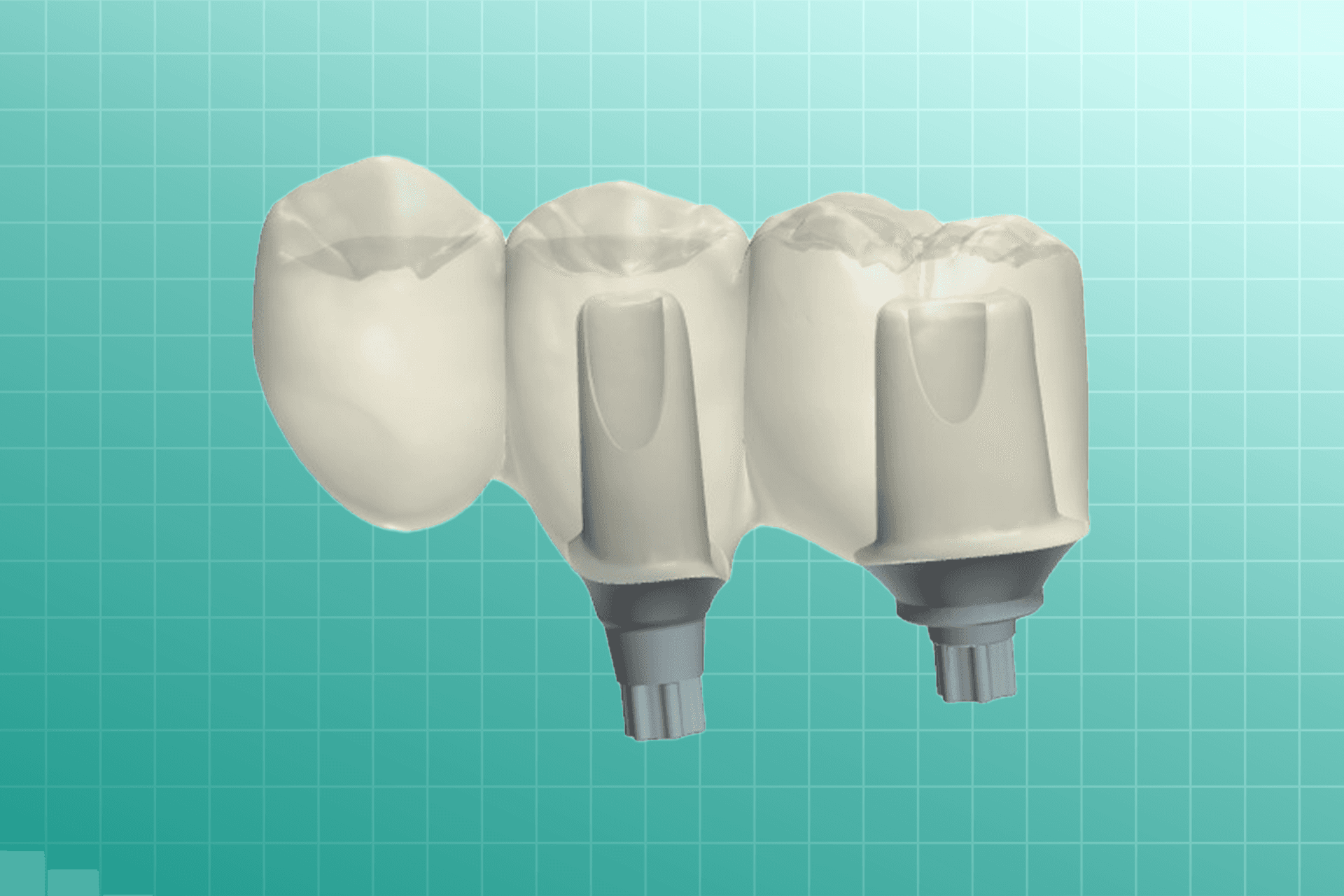 Custom Abutments dental prosthesis