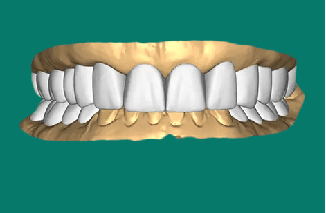 An assortment of different dental prosthetic options.