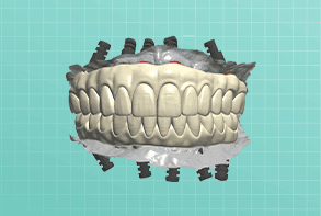 All-on-X dental prosthesis
