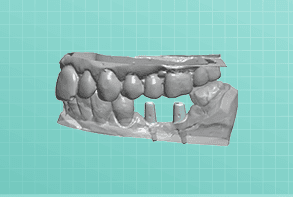 Custom Abutments dental prosthesis