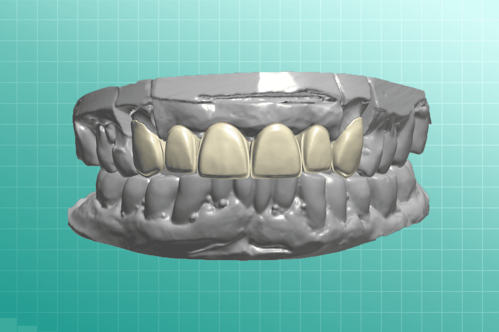 Facial Cutback dental prosthesis