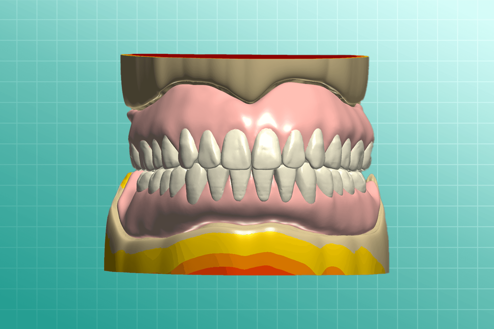 Digital Dentures dental prosthesis