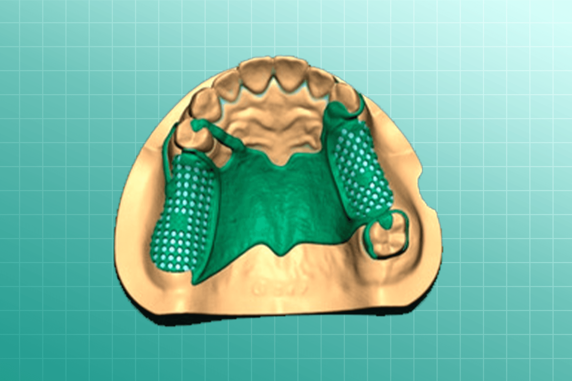 Removable Prosthesis