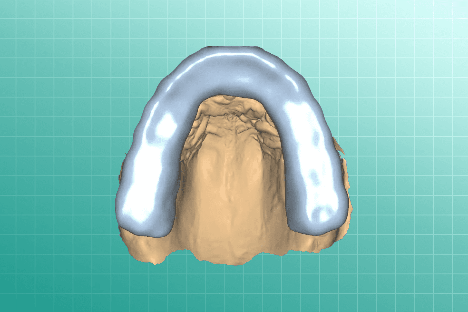 Sport Guards dental prosthesis