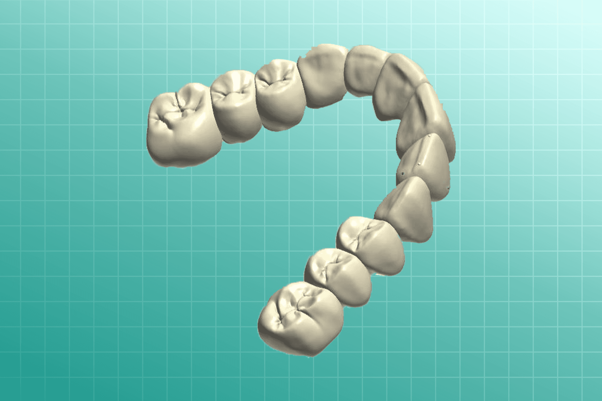 Snap-On Smile dental prosthesis