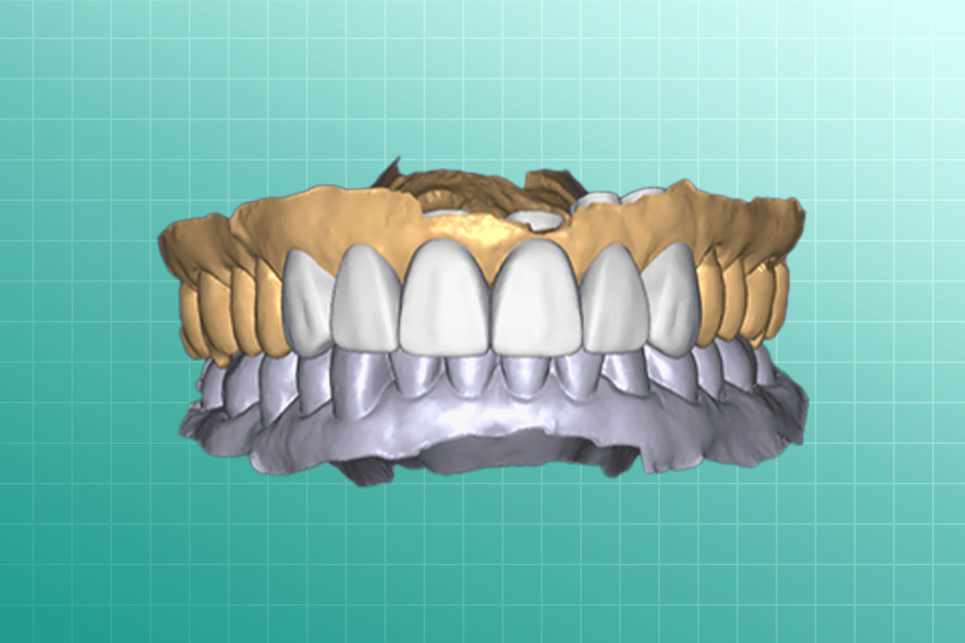 Digital Wax-Up dental prosthesis