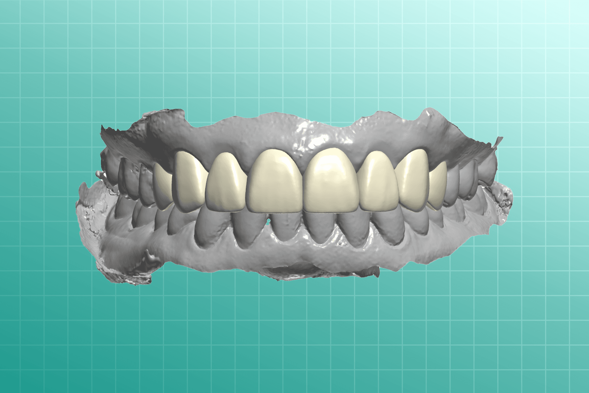 Veneers dental prosthesis